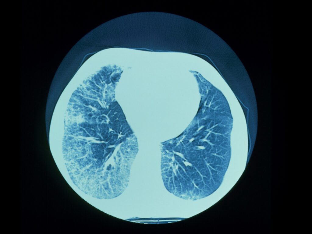 Global Progressive Fibrosing Interstitial Lung Diseases (PFILD) Treatment Industry