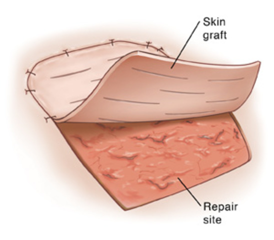 Skin Grafting Systems Market