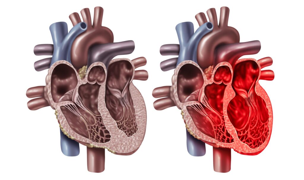 Takotsubo Syndrome Therapeutics Market