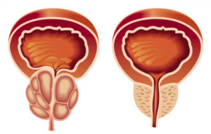 Benign Prostatic Hyperplasia (BPH) Prostate Treatment Market