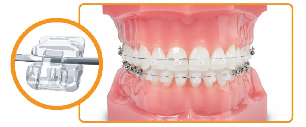 Dental Orthodontic Wax Market Dental Orthodontic Wax Market