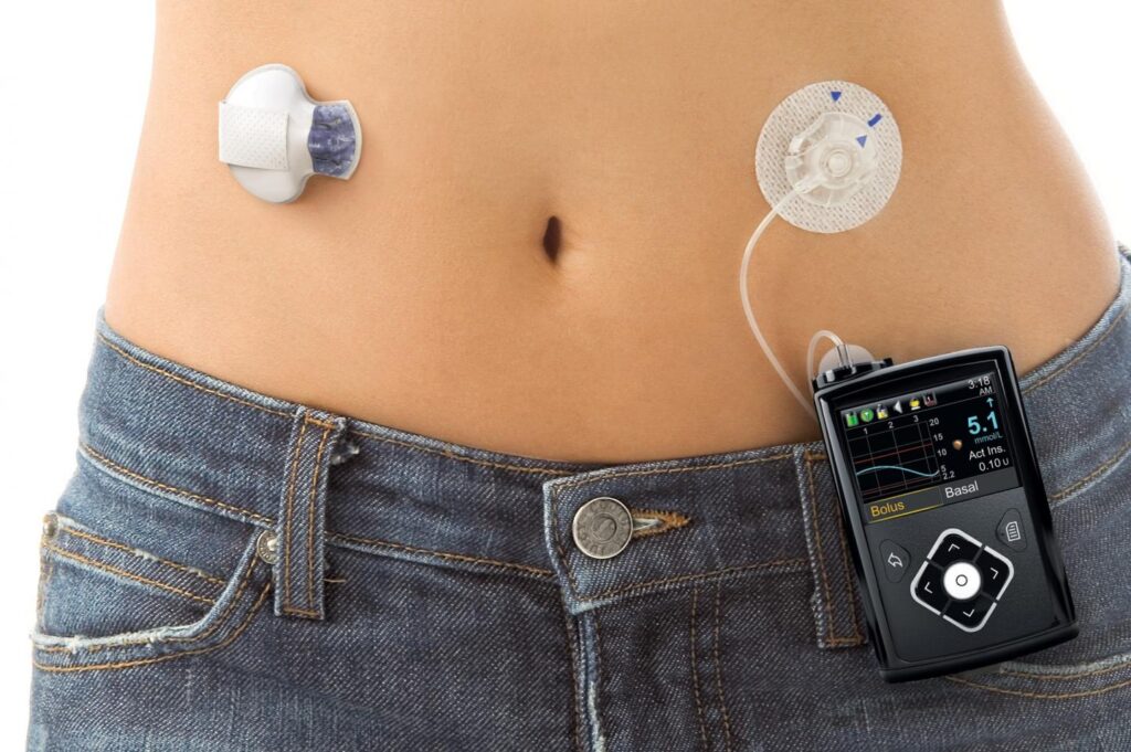 Insulin Pumps Market Insulin Pumps Market