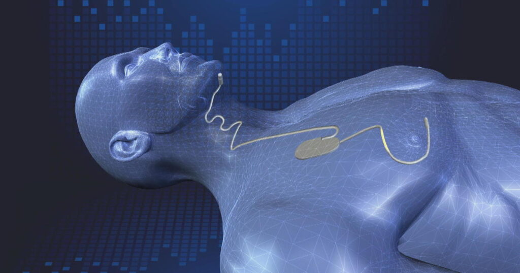 Sleep Apnea Implants Market Sleep Apnea Implants Market
