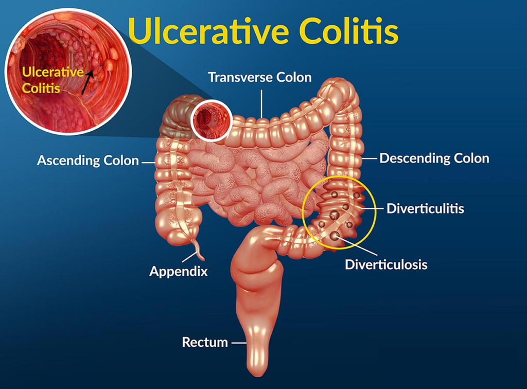 Ulcerative Colitis Treatment Market