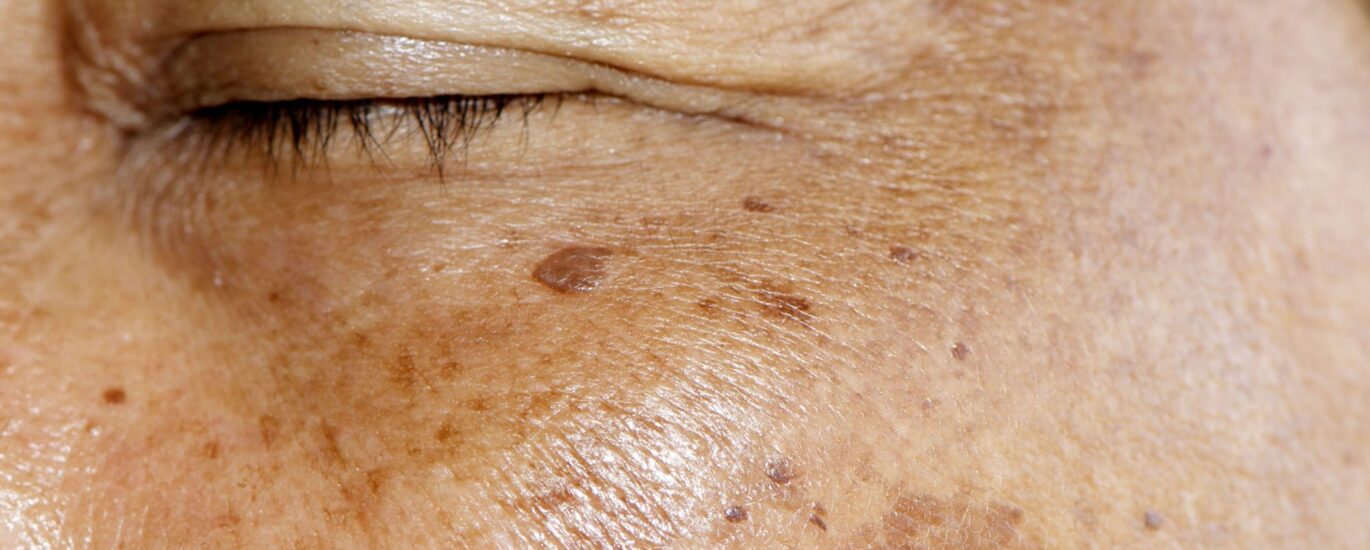 Global Actinic Keratosis Treatment Market