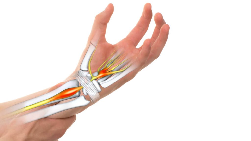 Carpal Tunnel Release Systems Market Carpal Tunnel Release Systems Market