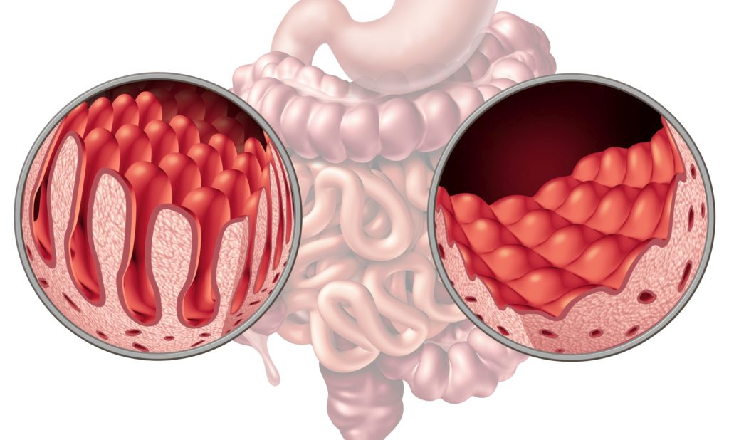 Celiac Disease Diagnostics Market