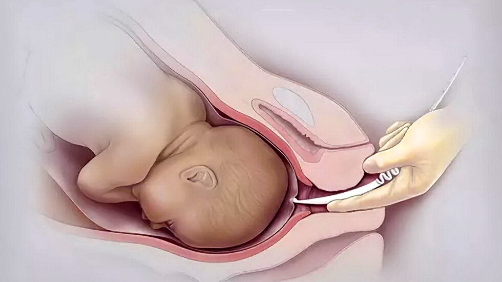 Amniotic Membrane Market