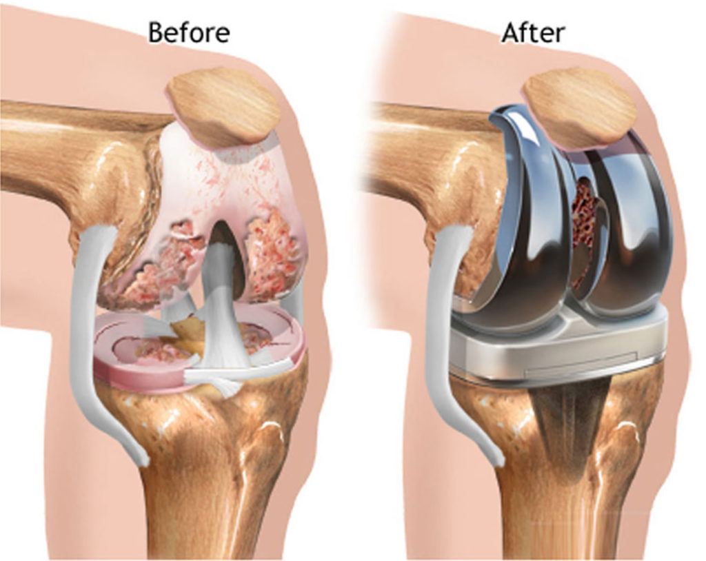 Joint Replacement