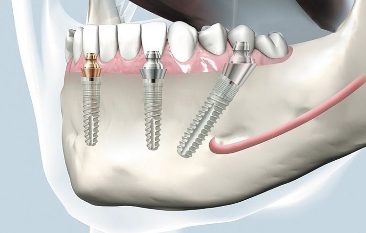 Non-Surgical Bio-Implants Market