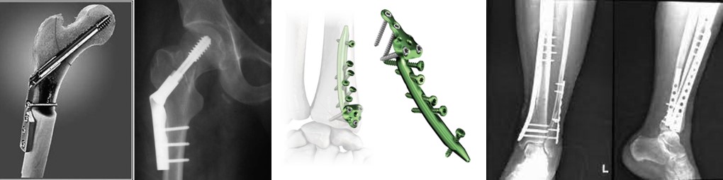 Spinal Osteosynthesis Units