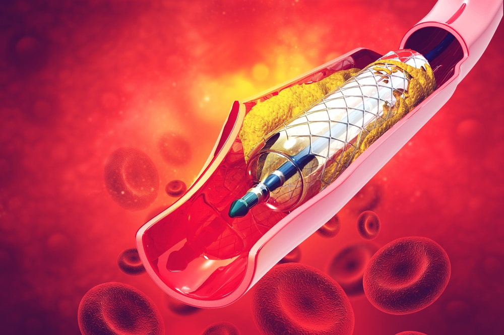 Venous Stents Market