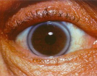Bullous Keratopathy Market