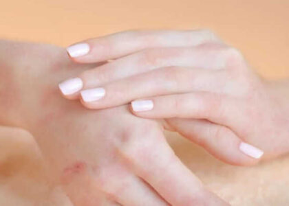 Canine Atopic Dermatitis Treatment Market