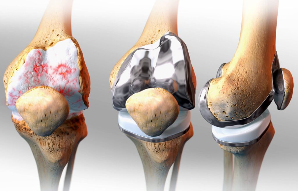 Cartilage Repair Market