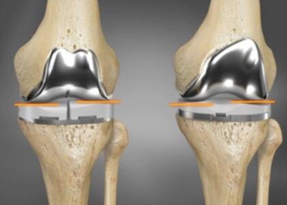 Hip and Knee Reconstructive Market