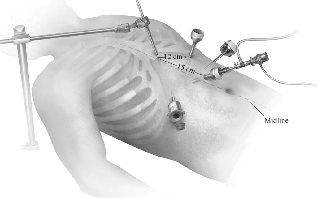 Hernia Repair Devices Market