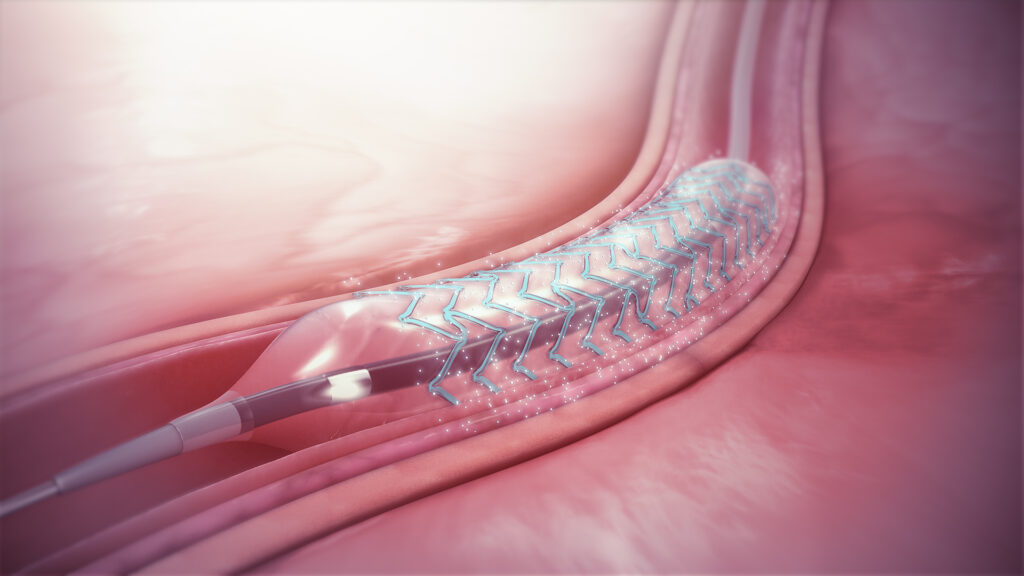 India’s Coronary Stent Market