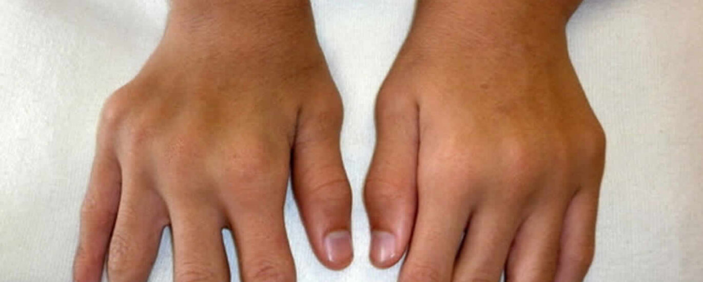 Mucopolysaccharidosis Treatment Market