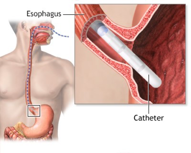 Esophageal Catheters Market