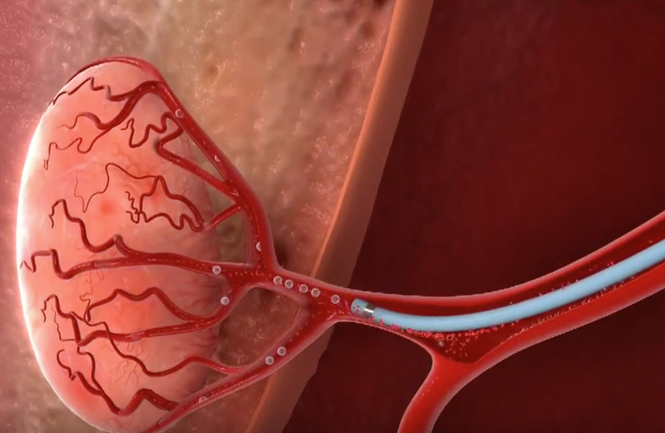 Intrasaccular Embolization Systems Market