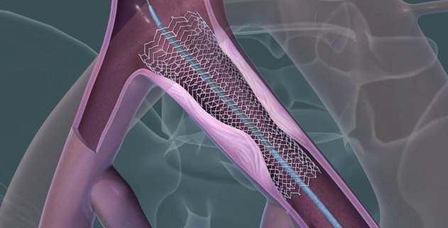 Venous Stents Industry