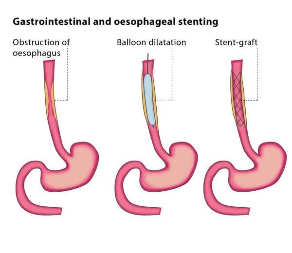 Gastrointestinal Stents Market