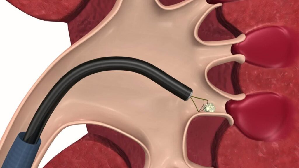 Kidney Stone Extraction Balloon Market Report – Trends & Forecast 2022-2032