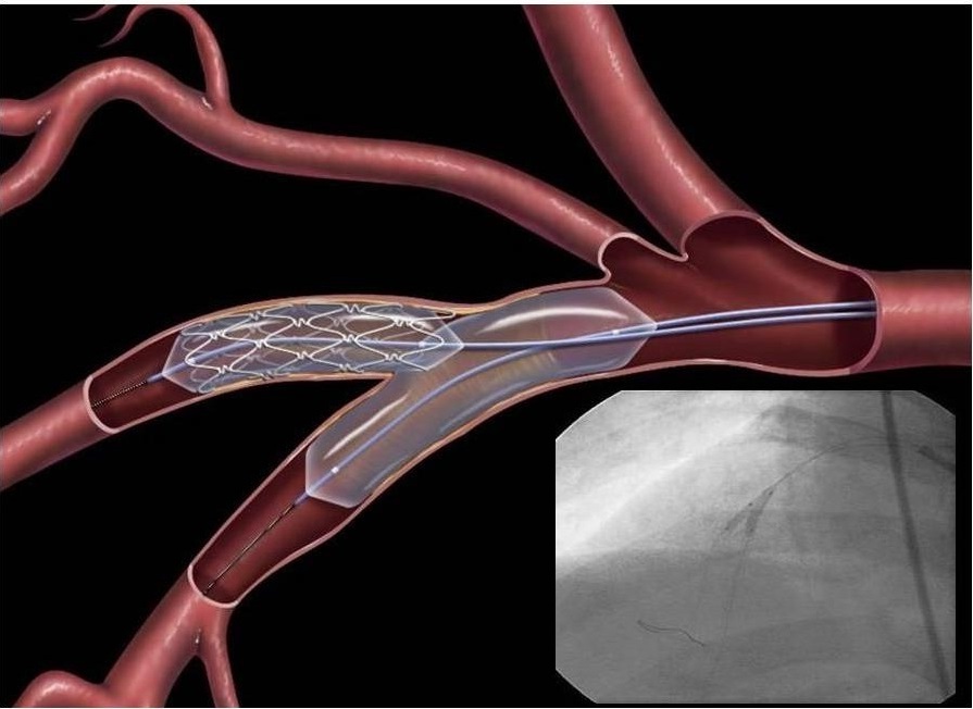 Thoracic Vascular Stent Grafts Market