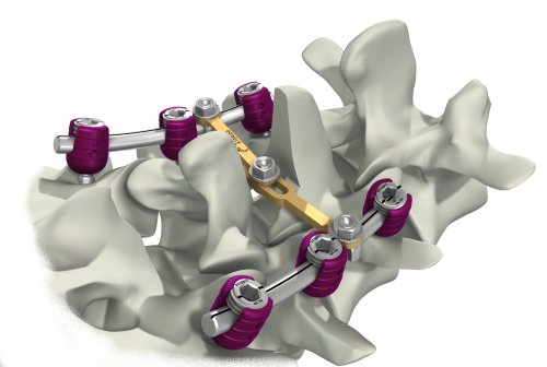 Thoracolumbar Stabilization Devices Market