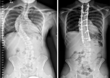 Scoliosis Management Market