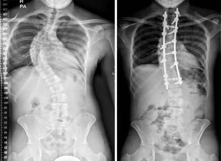 Scoliosis Management Market