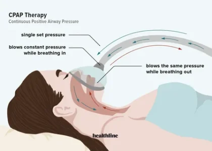 UK Continuous Positive Airway Pressure (CPAP) Market